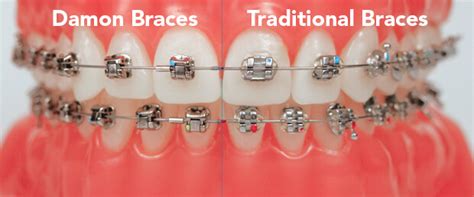 damon brackets vs metal braces|damon braces cost vs traditional.